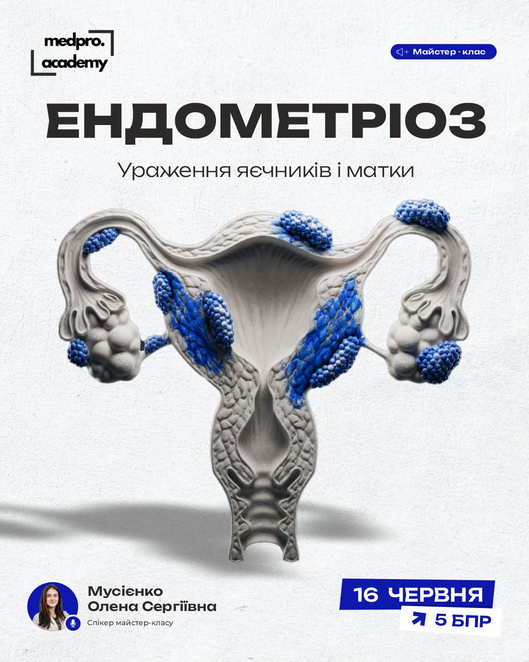 3Ендометріоз ураження яєчників і матки